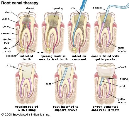 through a sinus tract that